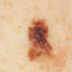 Melanoma Skin